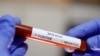 Coronavirus: Italia și România încep testarea „asimptomaticilor”